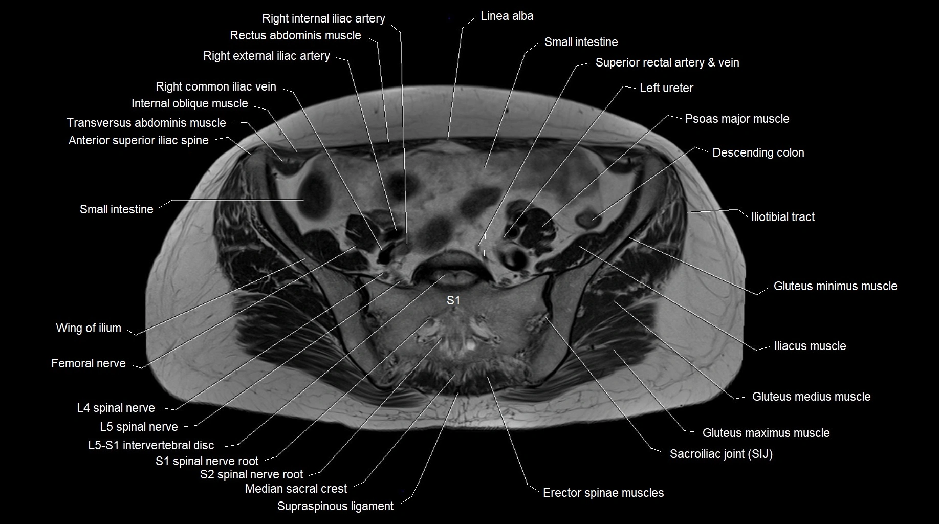 MRI 3T pelvis axial cross section anatomy image 10.webp